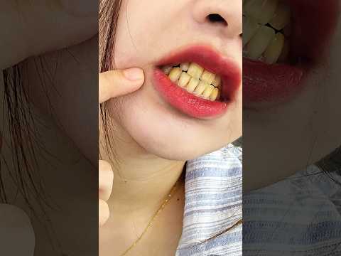 Kenapa Gigi Manusia Bisa Kuning