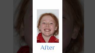 Braces transformation! #braces #orthodontics #orthodontist