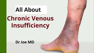 Chronic Venous Insufficiency (Cankles) - Risk Factors, Symptoms & Treatment