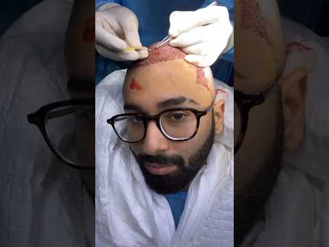 Orry's hair transplant 😲               #orry #orhanawatramani