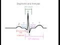Decoding EKG/ECG Basics