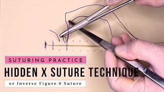 Hidden X Suture Technique, also known as Inverse Figure-of-Eight Suture