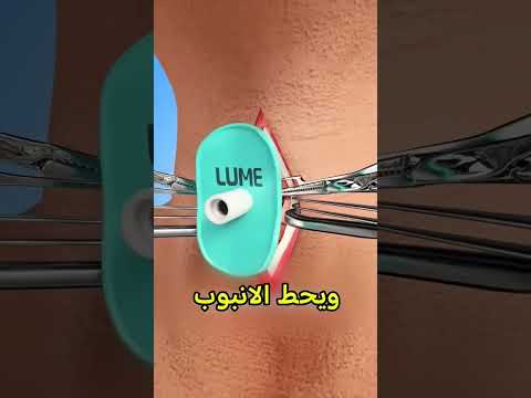 عملية خطيرة😨 #اكسبلور #shorts #foryou #explore #funny #معلومات