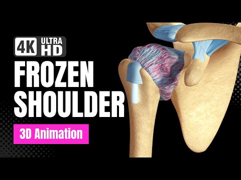 Understand Frozen Shoulder (Adhesive Capsulitis) - 4K 3D Animation