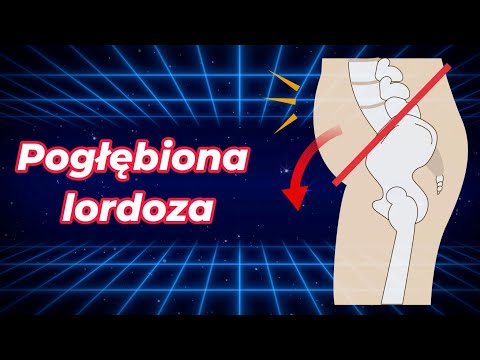 Wystający brzuch i pośladki? To hiperlordoza - skorygujmy to