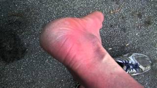 Morning flare up with ERYTHROMELALGIA, very painful