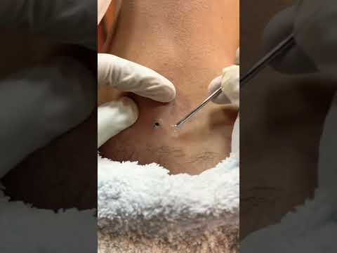 Blackhead 🤢 Removing #satisfying #shorts