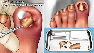 ASMR 꽉 끼는 신발 때문에 생긴 내성발톱 치료하기! 발톱 스케일링 애니메이션 | Ingrown Toenail removal treatment animation