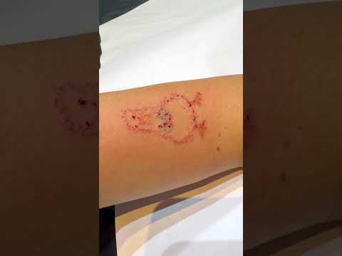 REMOVENDO A TATUAGEM DO PATOLINO *me arrependi*