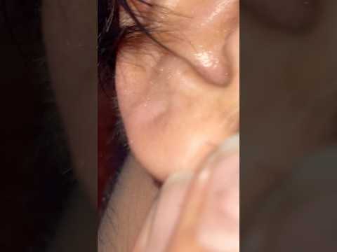 #ingrownhair #inspiration #satisfying #shortsfeed #shortvideo