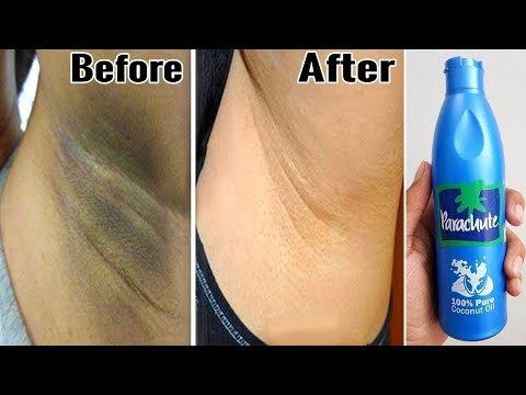 5 मिनिट में DARK SKIN से छुटकारा पाए Whiten Dark Elbows and Knees | Lighten Dark Body Parts