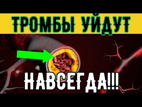 4 СУПЕР СПОСОБА ИЗБАВИТЬСЯ ОТ ТРОМБОВ НАВСЕГДА!