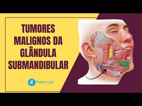 Tumores Malignos da Glândula Submandibular: Diagnóstico e Tratamento que Você Precisa saber