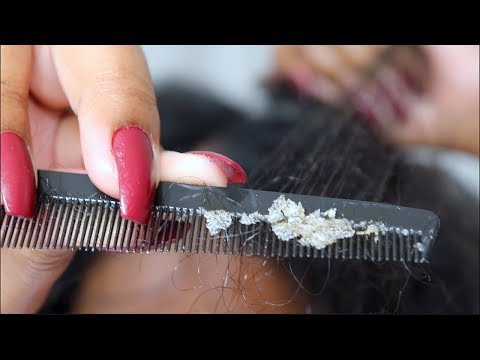 Dandruff Scratching  | ASMR Dandruff Flakes