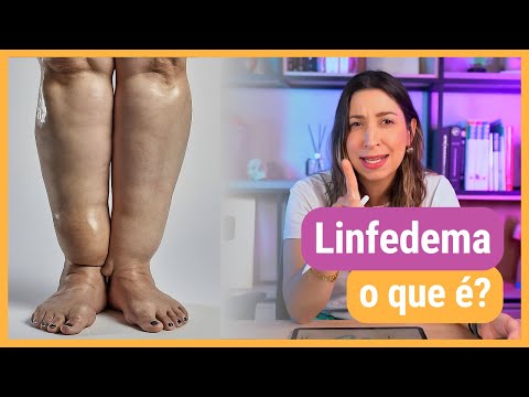 LINFEDEMA: o que é, causas e tratamento