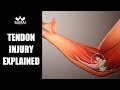 Understanding Tendon Injuries and Prevention