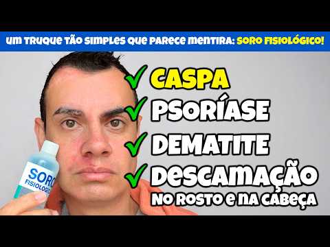 SÓ ISSO acaba com a CASPA, PSORÍASE e DERMATITE! Eu fiz e FUNCIONA!