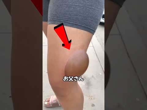 なぜ水ぶくれができるの？つぶしたらどうなるの？