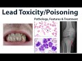Lead Poisoning and Its Effects