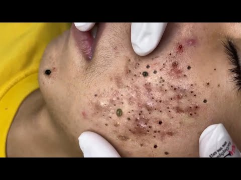 Big Cystic Acne Blackheads Extraction Blackheads & Milia, Whiteheads Removal Pimple Popping # 46744