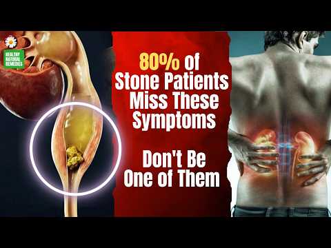 80% of Stone Patients Miss These Symptoms. Are Your Kidneys in Trouble? #kidneystone