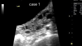 🩺 PCOD vs PCOM Ultrasound: Comparison of 3 cases | Mild, Classical & Severe Polycystic ovaries 