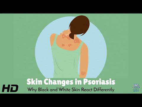 Psoriasis in Black vs. White Skin: What You Need to Know