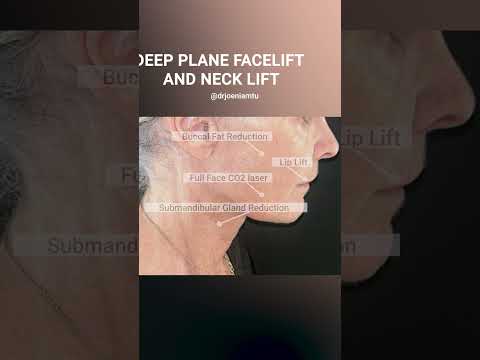 Deep plane facelift & neck lift #deepplanefacelift #necklift #browlift #foreheadlift