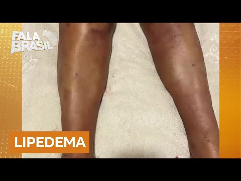 Lipedema: Celebrações, tratamentos e hábitos para lidar com a doença que afeta mulheres