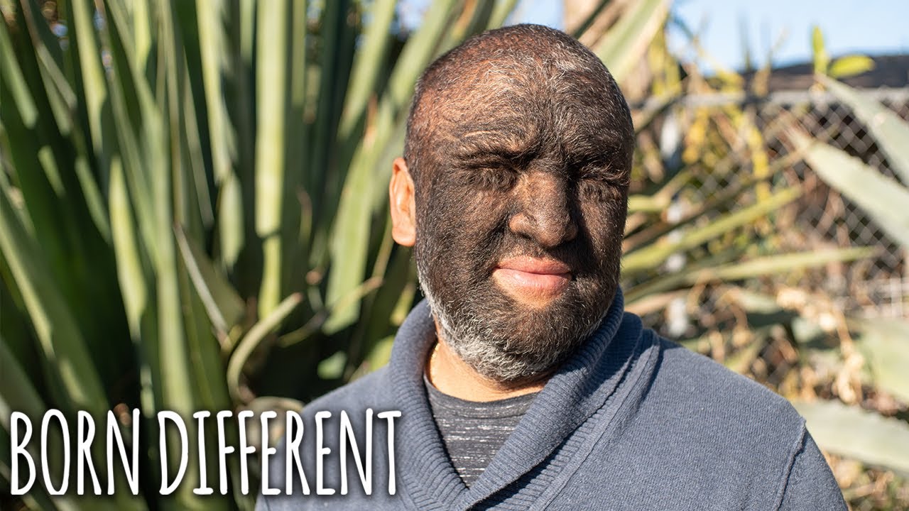 'wolf man' is 95% covered in hair - born different