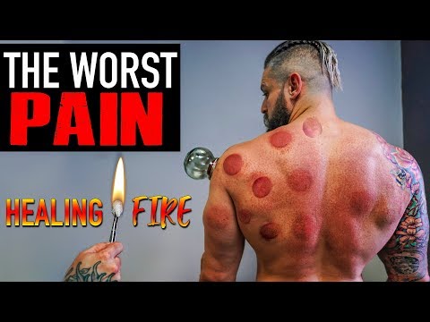 The WORST PAIN - Can FIRE CUPPING / Hijama Fix Muscle Injury??  (Lex Fitness Before & After Results)