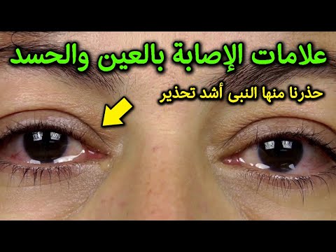 علامات تدل على انك مصاب بالعين والحسد وانك فى خطر كبير ؟ اياك ان تتجاهلها ؟ حذرنا منها النبي ﷺ !
