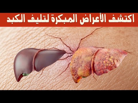 اكتشف الأعراض المبكرة لتليف الكبد علامات يجب عدم تجاهلها