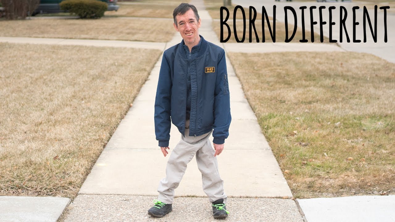 The incredible man with legs like scissors - born different