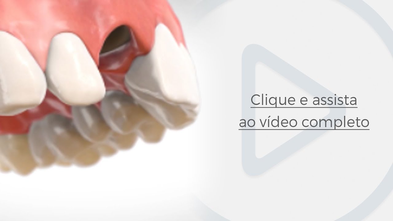 Cirurgia Guiada de Implantes Dentários sem cortes