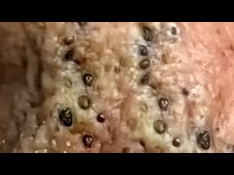 Blackheads & Whiteheads Satisfying Removal @0378