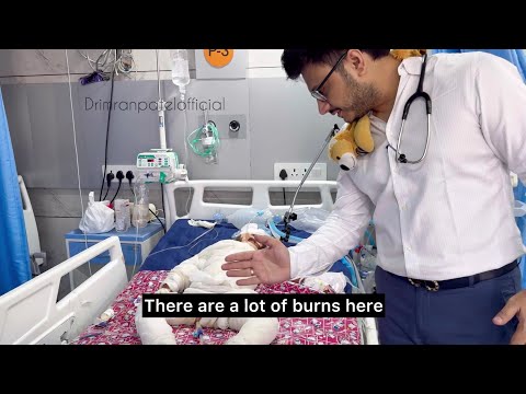 Severe Burn In Children Please Take Precautions And Avoid Such Horrible Accidents | Dr Imran Patel
