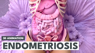 Endometriosis | 3D Animation