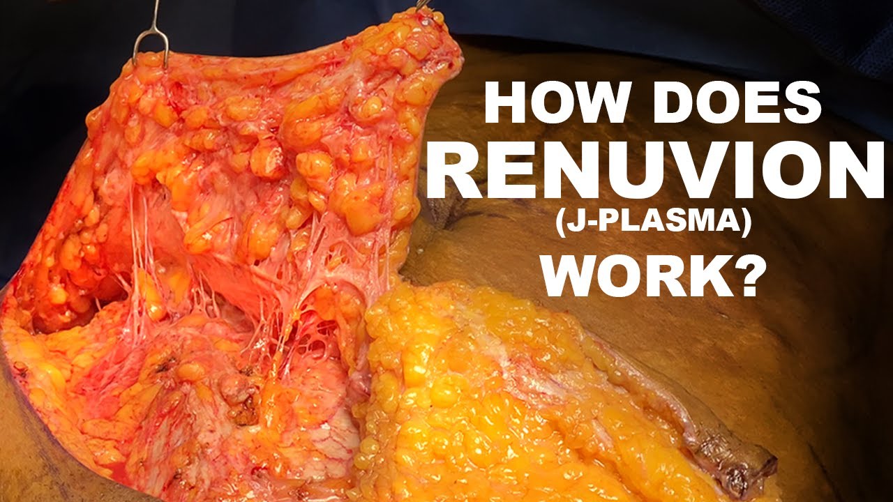 J-Plasma technology demonstration in medical procedure.