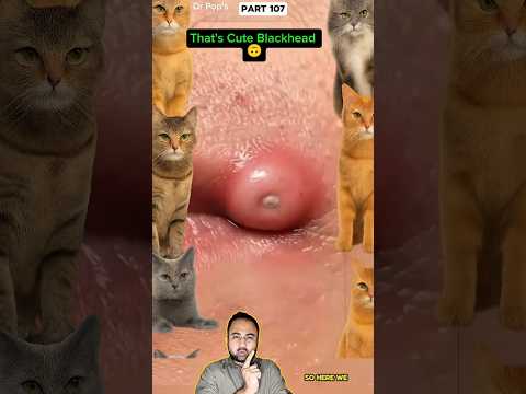 Blackhead Compress – You Won’t Expect This #shortsfeed #Shorts