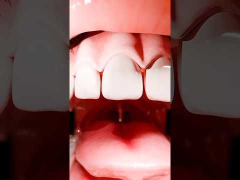 How Dentists Repair a Broken Tooth 😱