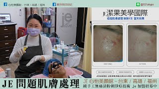 JE無痛清粉刺淨痘技術 #林季儀老師  #外泌體育膚新技術 #加盟店招募中