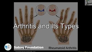 Arthritis and Its Types