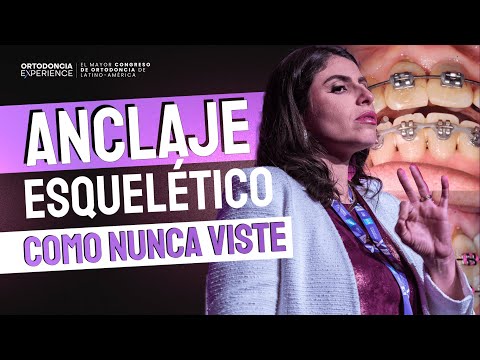 Lo mejor del OX 2025: Nuevas técnicas para compensar al paciente adulto con anclaje esquelético