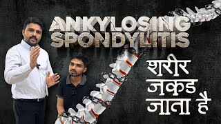 ankylosing spondylitis treatment by Dr. Harish Grover