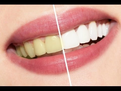How to Have Natural White Teeth in 2 minutes (Works 100%)