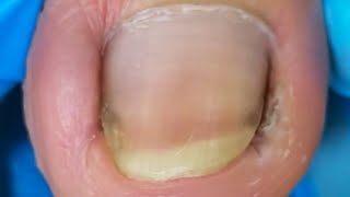 There Is Obvious Black Mud On The Toenails, Clean It!【Crazy pedicure room】