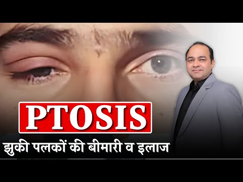 लटकी हुई पलक (Ptosis) का कारण और इलाज | Eyelid Drooping Treatment in Hindi | Dr. Rawat Choudhary