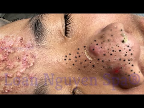 Blackhead Removal With Sac Dep Spa @100074093