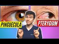Pterygium and Pinguecula Overview